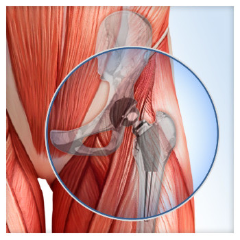 Total hip replacement is a common orthopedic procedure. As the population ages, it is expected to become even more common. Hip replacement surgery involves removing the head of the thighbone (femur) and replacing the ball-and-socket mechanism of the hip with artificial implants. This relieves pain and improves mobility.