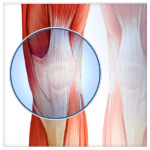 Knee Surgery - Naples - Dr. Mead